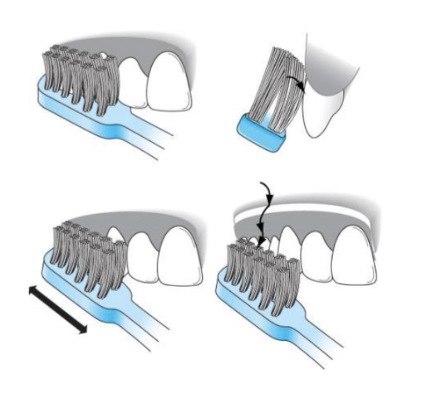 <ul><li><p>sides of bristles placed partly on teeth and gingiva </p></li><li><p>vibratory strokes at gingival margin </p></li><li><p>rolled stroke to clean coronal surface </p></li></ul><p></p>