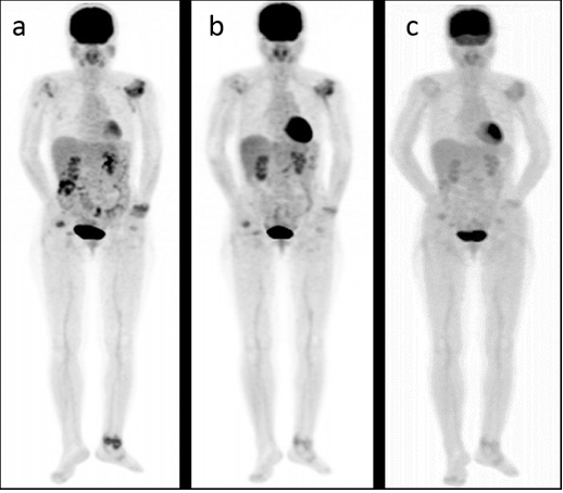 <p><strong>nuclear medicine study that uses injectable radiotracer with a scan to evaluate function (blood flow, O2 use, glucose metabolism) visualizing uptake of radiotracer and look for metastasis </strong><br>-assesses ischemic areas of heart<br>-used in neurology to evaluate tumors, seizure</p>