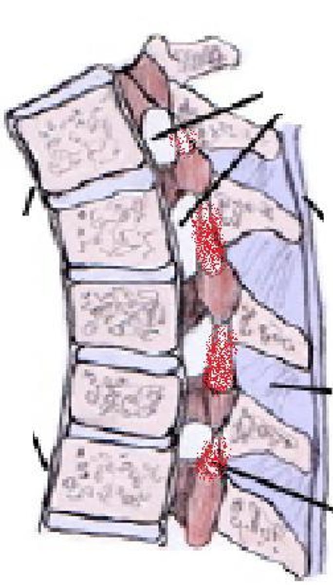 <p>These ligaments connect the laminae of each vertebrae and form part of the posterior surface of the vertebral canal. It runs from the anterior part of the lamina superiorly to the posterior aspect of the inferior vertebrae's lamina. It resists separation of the laminae during flexion of the spine.</p>