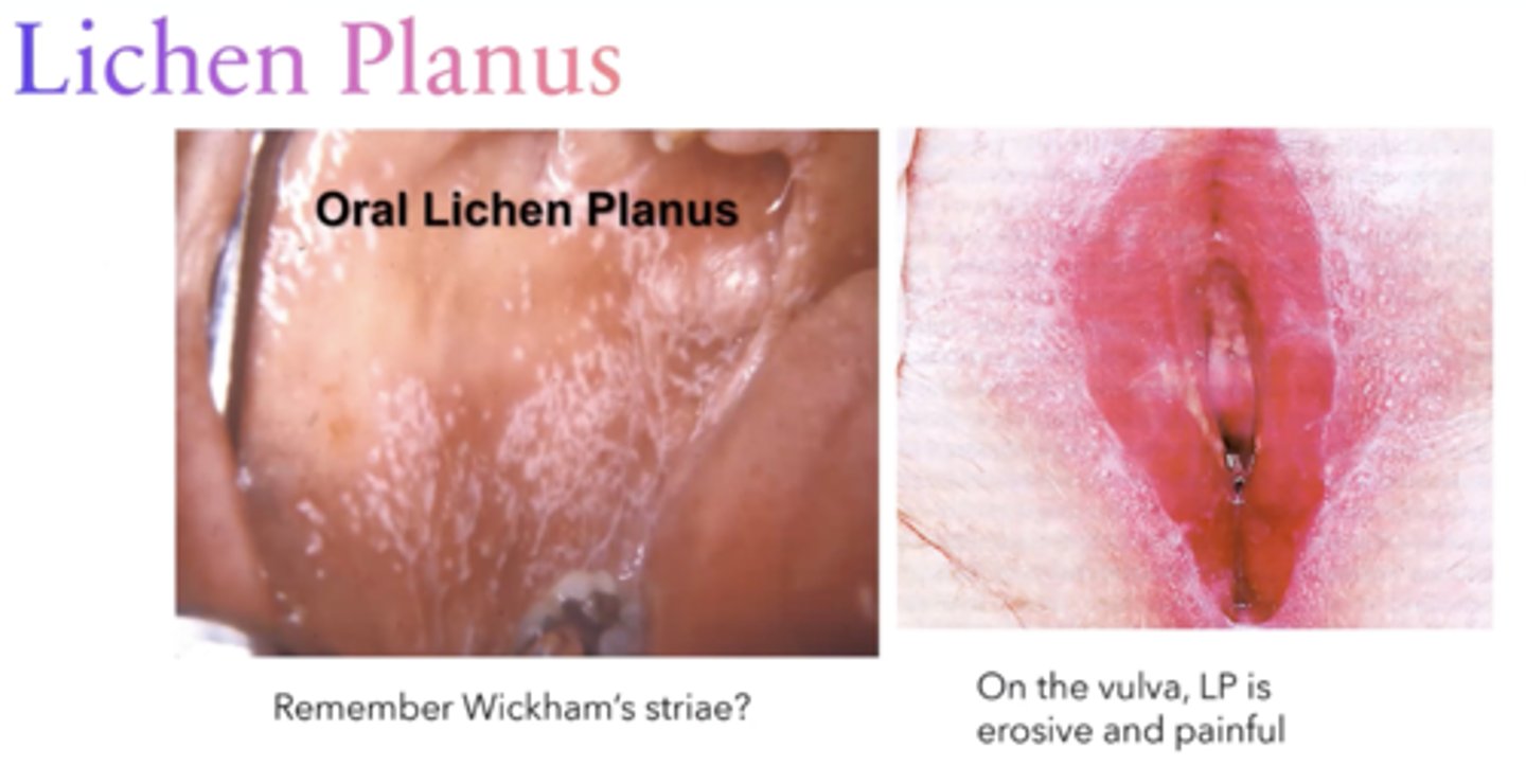 <p>Erosive</p><p>Wickam's striae</p><p>Painful!</p>