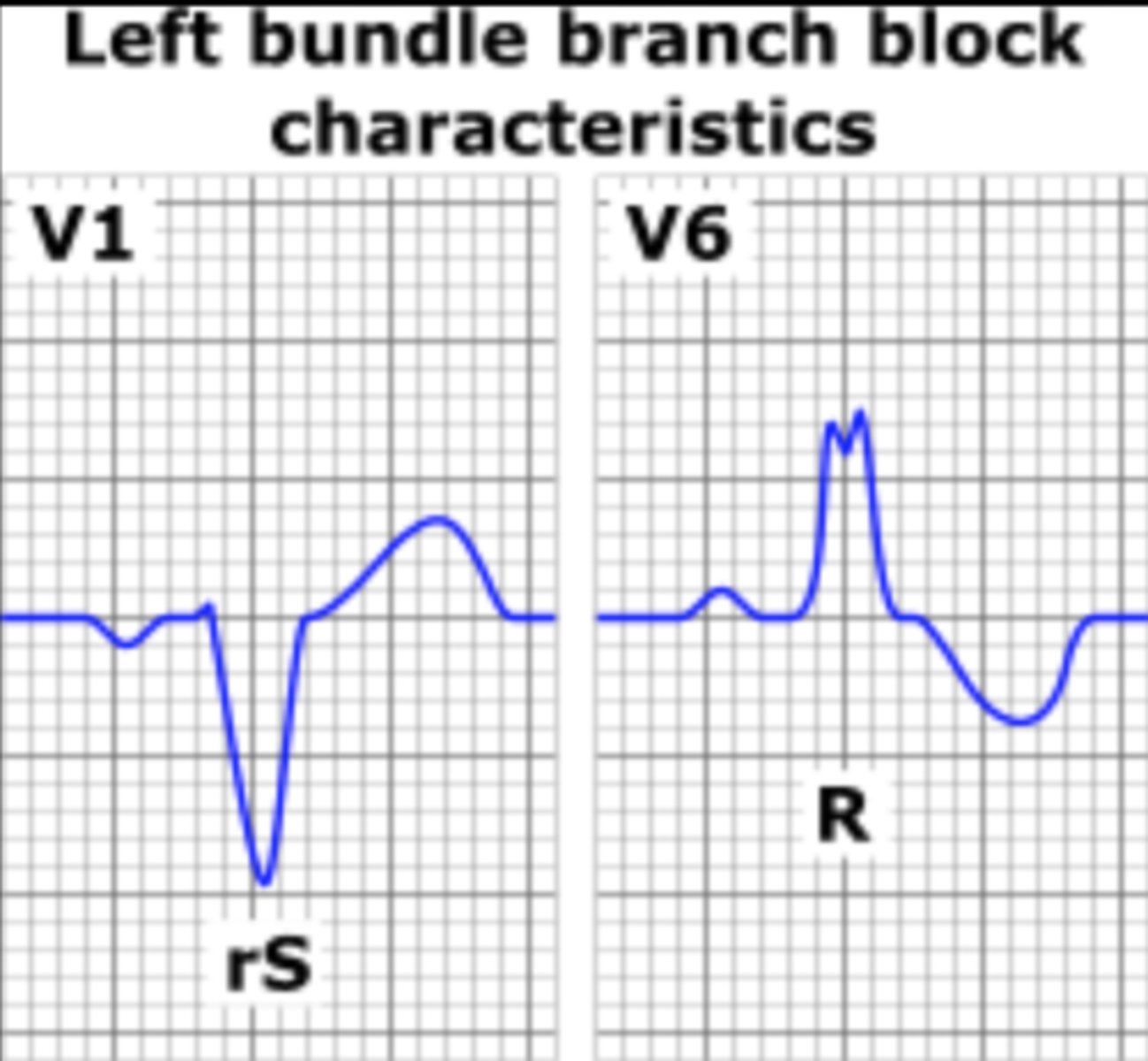 <p>Leads V5 &amp; V6</p>