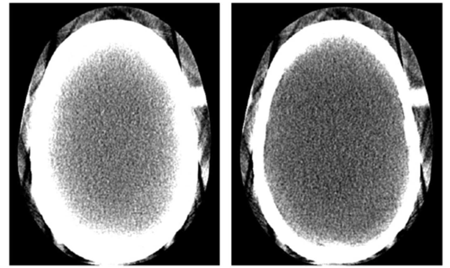 <p>1) as the X-ray beam passes through an object, lower energy photons are removed (like filtration!) leaving a "harder beam" of high energy photons. This causes two artifacts:</p><p>2) Cupping: the center of a round object is darker than the periphery due to hardening of the beam 360 degrees around the object. happens in the head</p><p>3) Streak: these are dark bands that occur in between two dense objects - nearly all the photons are removed in a line between the two objects</p><p>4) fixes:</p><p>A) Filtration: pre-hardening the beam to remove low energy photons</p><p>B) Calibration: using a phantom to set a compensated mA/kVp</p><p>C) Correct software: iterative reconstruction may help</p><p>D) Avoidance: tilting the gantry of positioning the patient to avoid areas that may cause hardening.</p>