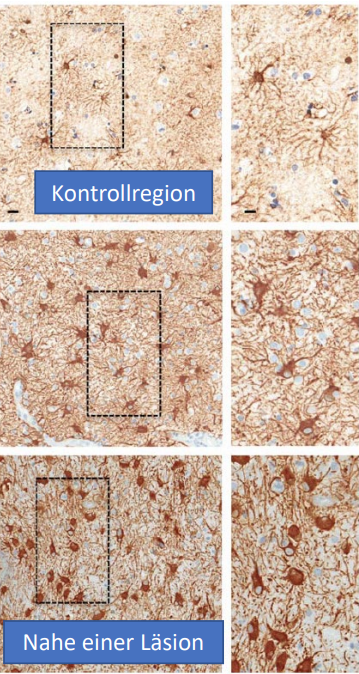 in der Nähe einer Läsion (Verletzung oder Störung der Funktion eines Organs oder Körperglieds):
- mehr Astrozyten
- mehr GFAP
=> kranke Stellen erscheinen dunkler und dichter
