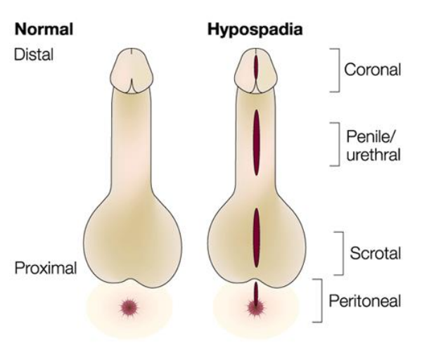 <p>A common variation in fetal development of the penis in which the urethra does not open from its usual location in the head of the penis.</p><p>2nd most common birth abnormality of the male reproductive system, affecting about one of every 250 males at birth.</p>