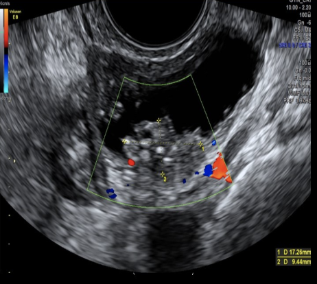 <p>which ovarian tumor contains <strong>both epithelial + stromal componenets</strong></p><p>a) thecoma</p><p>b) mucinous cystadenoma</p><p>c) serous cystadenoma</p><p>d) cystadenofibroma</p>