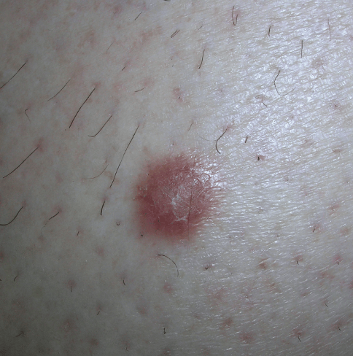 <p>name this skin pathology</p>