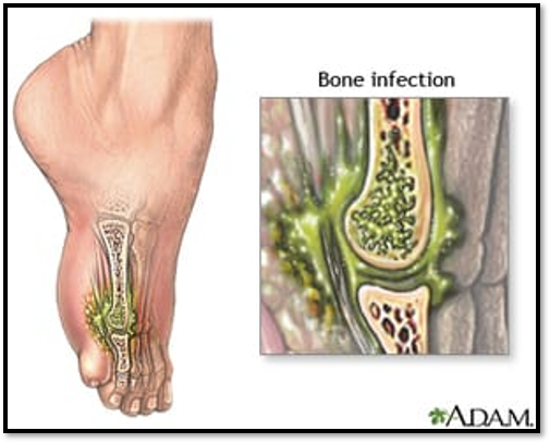 <p><span>Chronic Osteomyelitis (Local &amp; Systemic)</span></p>