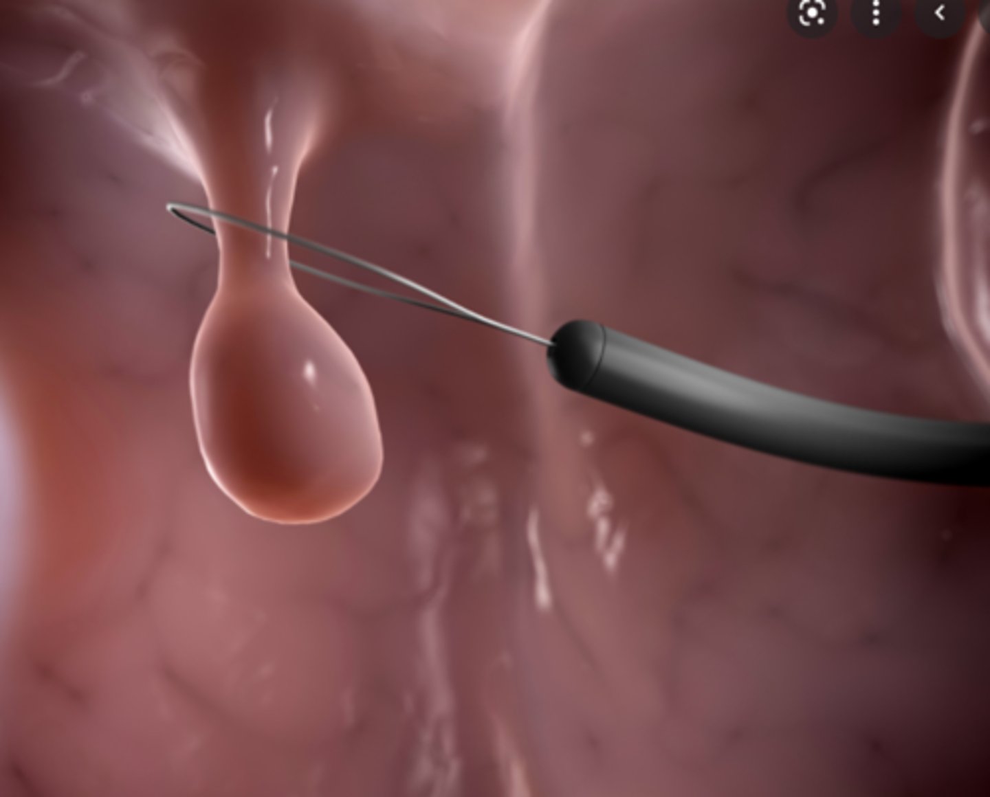 <p>What is cancer of the colon?</p>