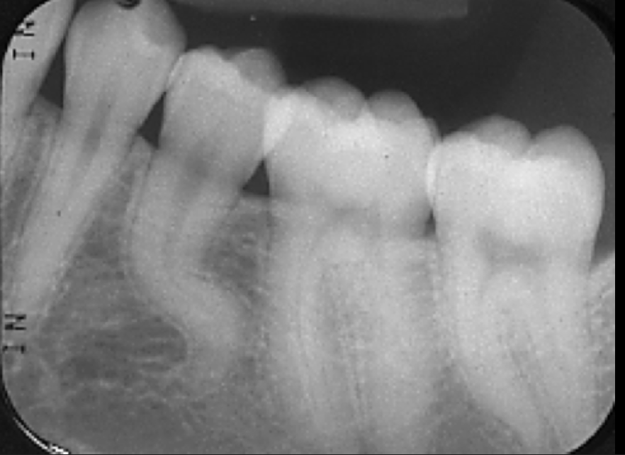 <p>If the contacts get worse as we move back in the mouth, what radiograph error is happening?</p>