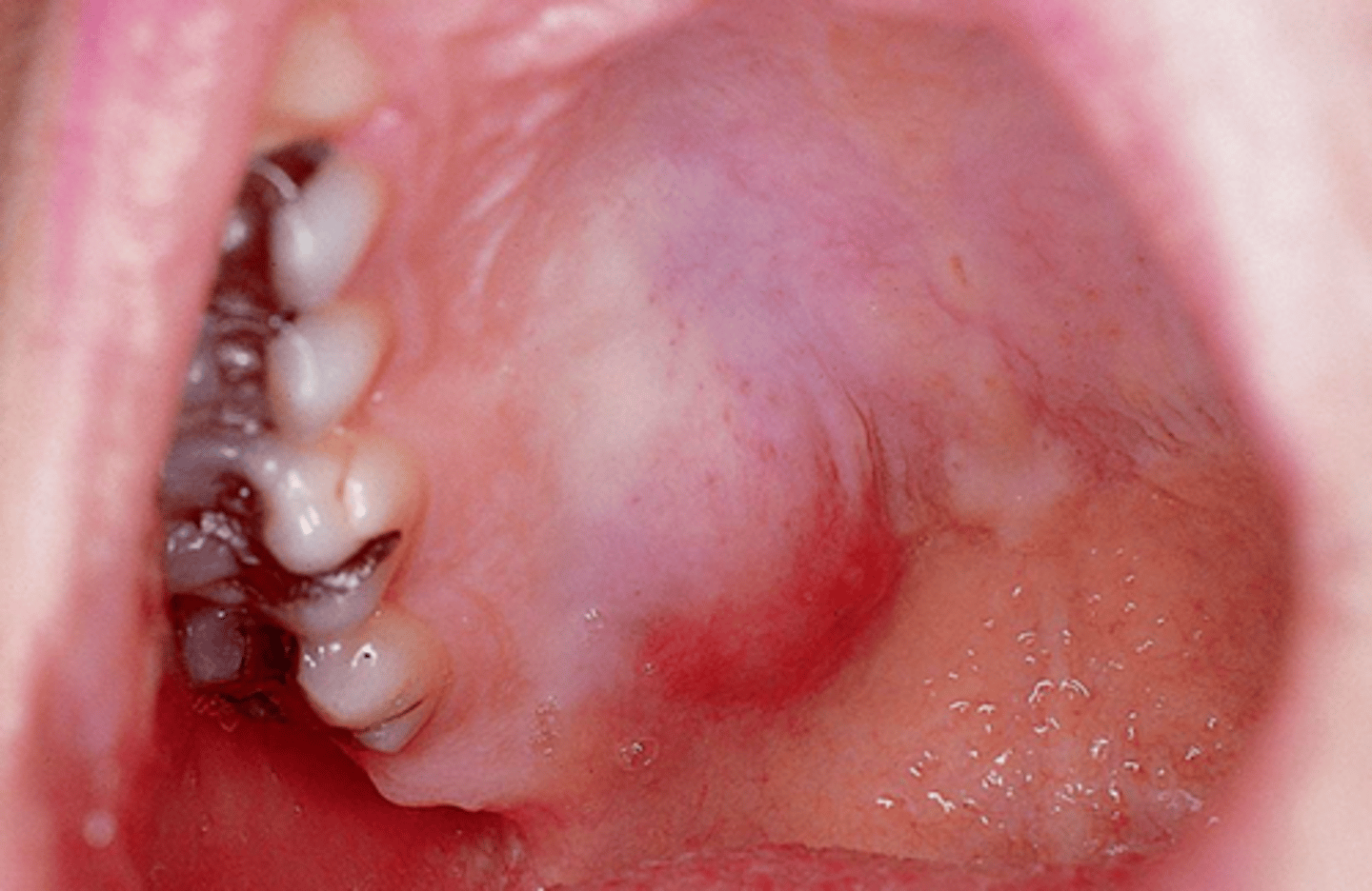 <p>Most common tumor of the salivary glands - benign.</p><p>•Parotid gland most common location.</p><p>•Hard palate (posterior) most common intraoral location.</p><p>•Painless, well-circumscribed soft tissue swelling</p>