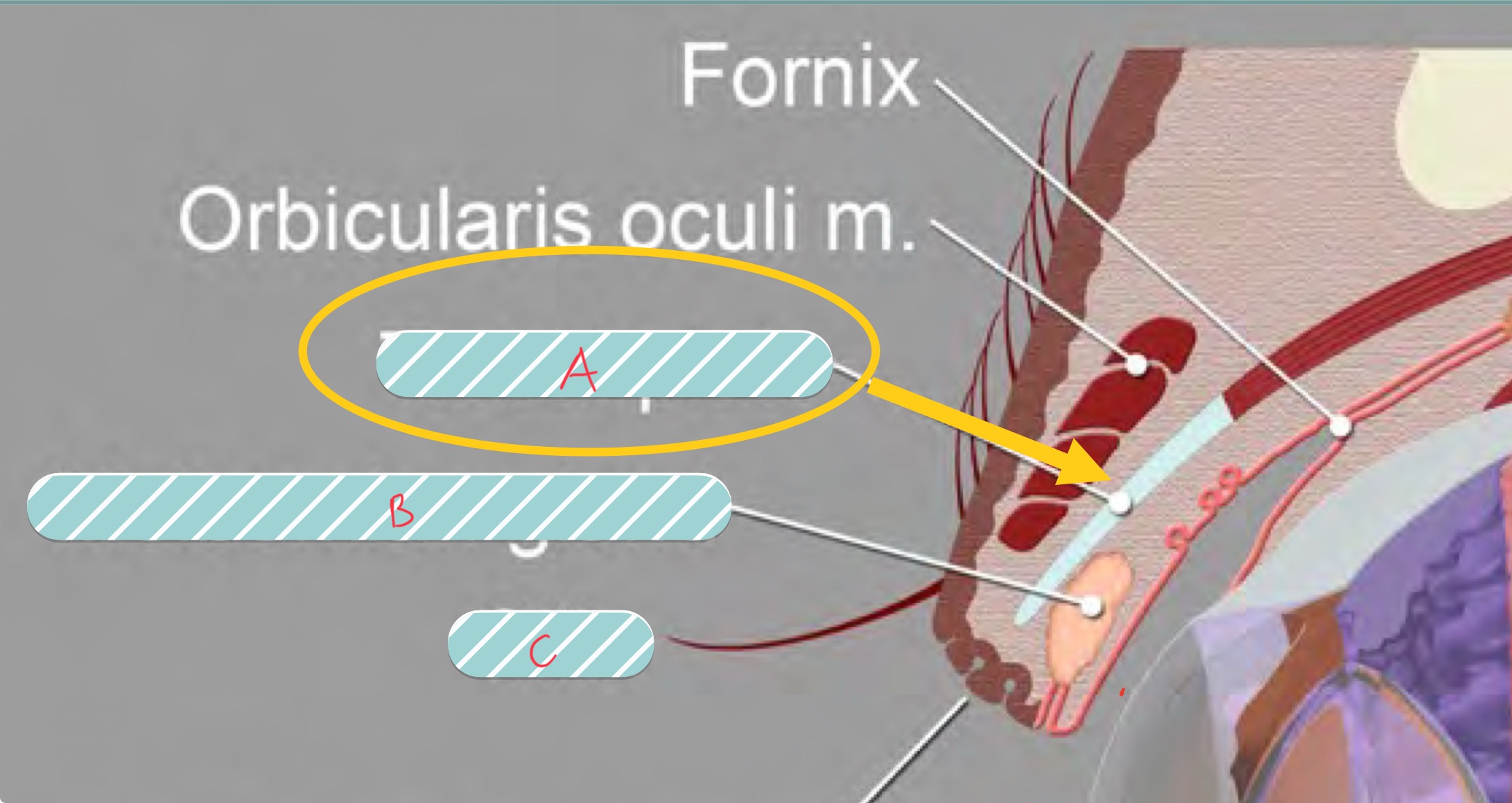 <p>label the covered structures of the eyelid</p>