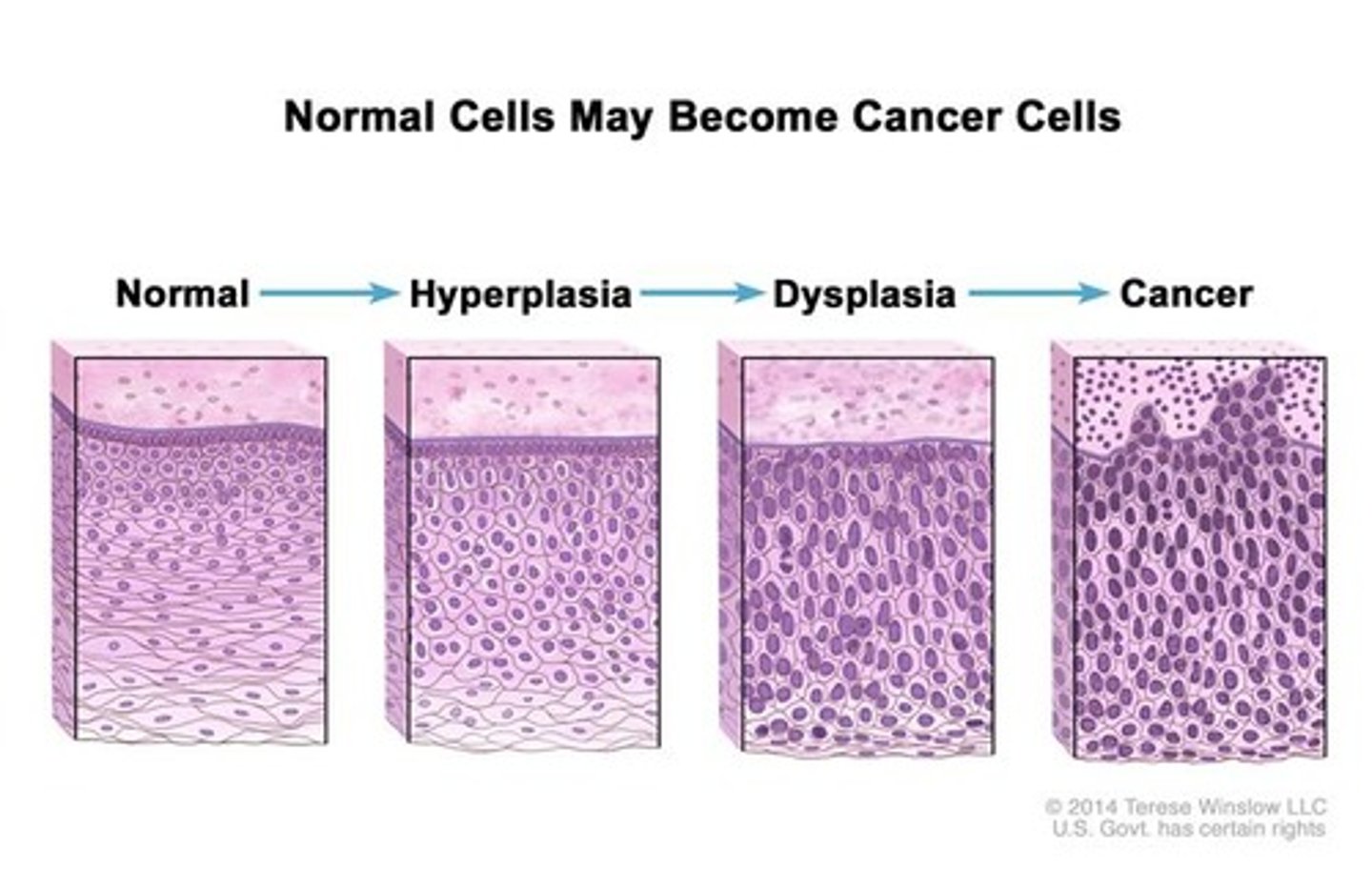 <p>morphological changes seen in cells in the progression to becoming cancer (cells become more 'jumbled up')</p>