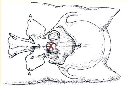 <p>Cisterna Megna Preparation </p>