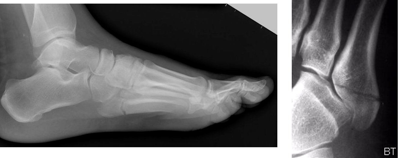 <p>fx to base of 5th metatarsal</p>