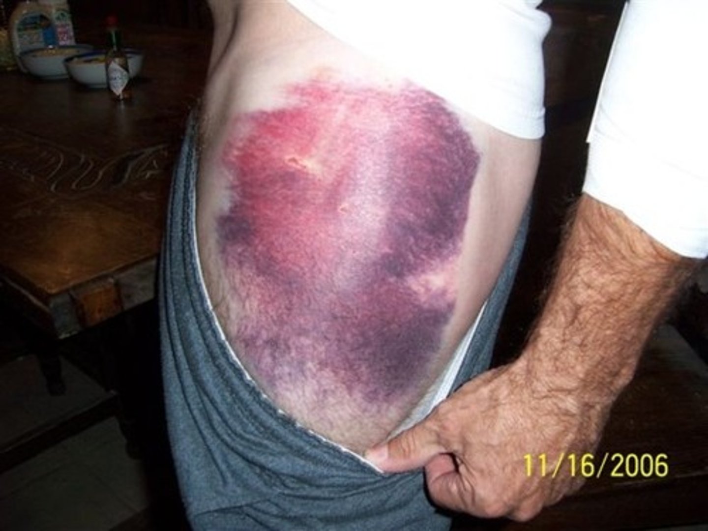 <p>skin discoloration consisting of a large, irregulary formed hemorrhagic area with colors changing from blue-black to greenish brown or yellow, commonly called a bruise</p>