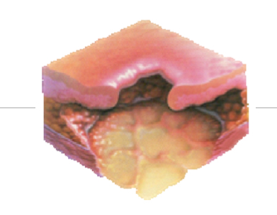 <p>Full-thickness tissue loss with exposed bone, tendon, and/or muscle </p><ul><li><p>Slough or eschar may be present </p></li></ul><p></p>