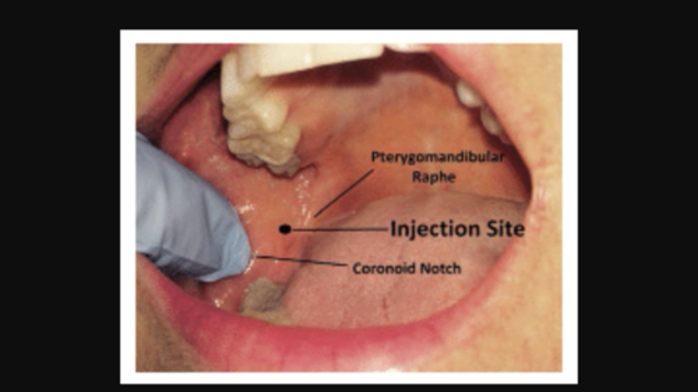 <p>above mand foramen</p>