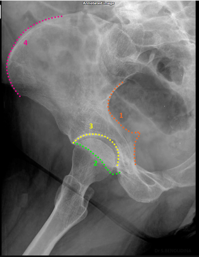<p>Posterior column.ilioschial(SHOWN #1 ORANGE)</p>