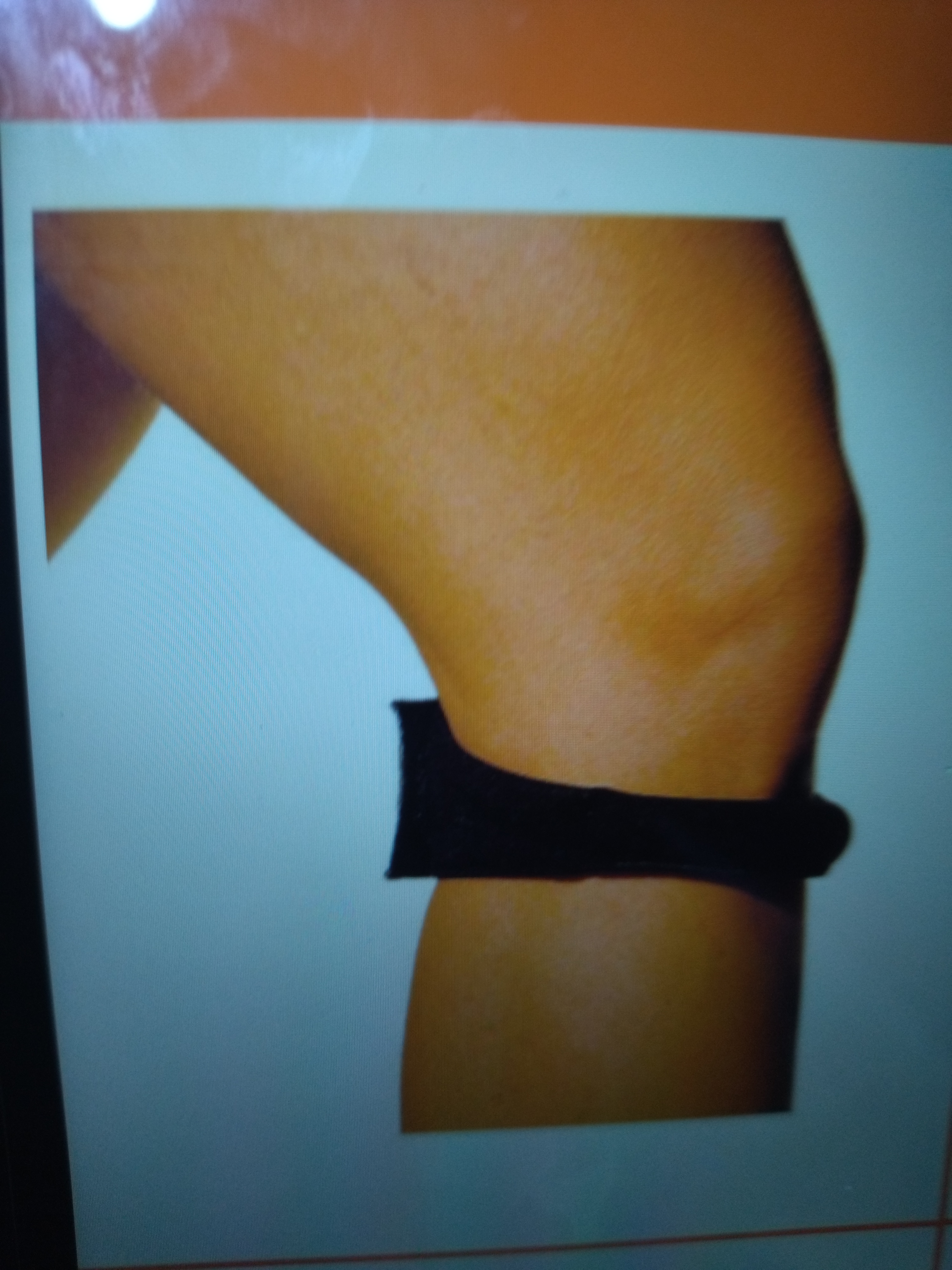 * Chondromalacia 
* Foam padded infra patellar straps that encircles the knee worn during the activity.