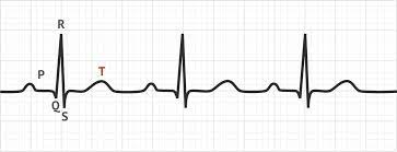 <p>Produced by repolarisation of ventricular contractile fibres. </p>