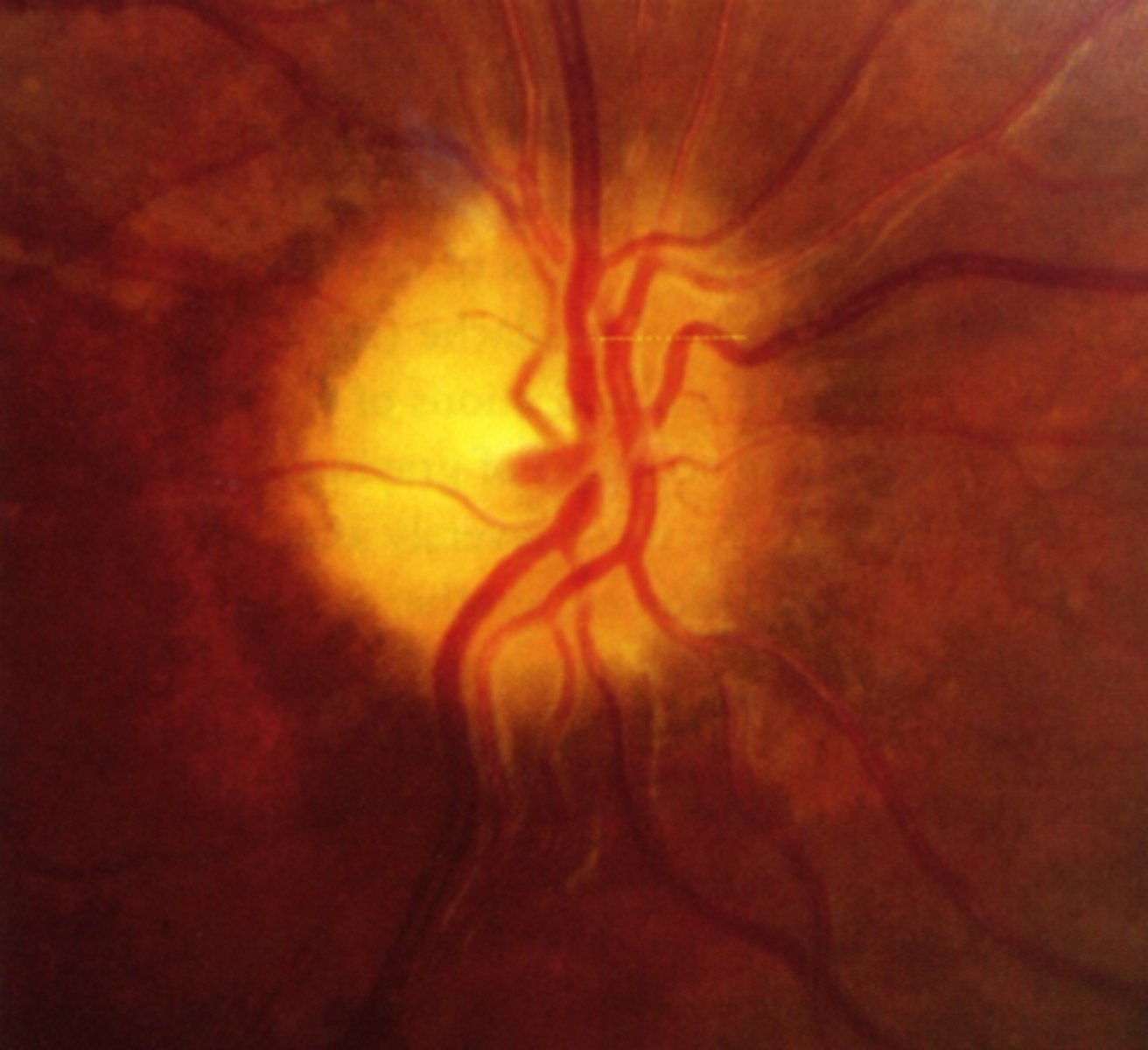 <p>chronic atrophic papilledema</p>