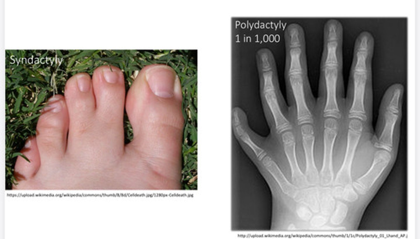 <p>Skeletal disorder that results from abnormal bone patterning, genetic or environmental. Extra digits or fusion of digits</p>