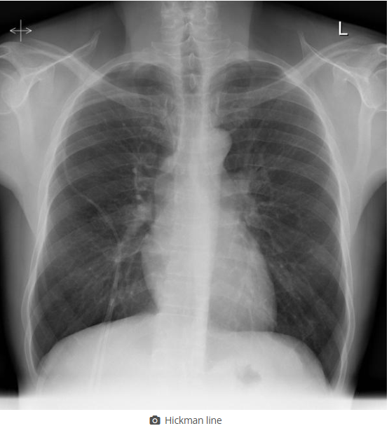 <p>on this image, find the tunneled catheter</p>