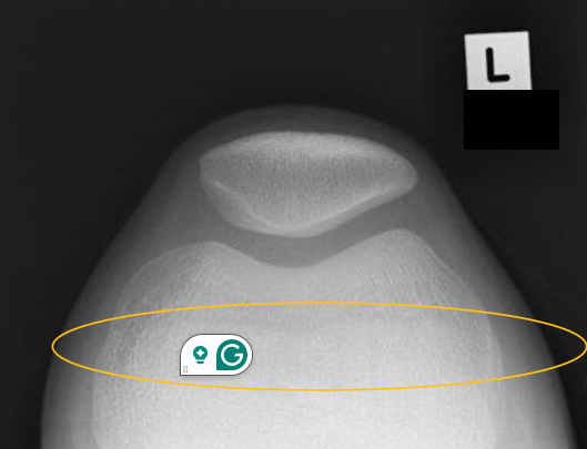 <p>good 60 flexion</p><ul><li><p>tib tub is post to sulcei and NOT seen in notch</p></li></ul><p></p><p>insufficient flexion</p><ul><li><p>tib anterior to sulcei</p></li></ul><p></p>