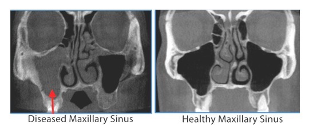 <p>Triad: pain/pressure of sinuses, headache, fever; also nasal congestion and purulent rhinorrhea, double sickening and sx persist longer than 7-10 days</p>