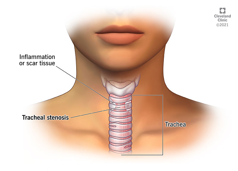 <p>trachea (rough)<br>eg. trachealgia</p>