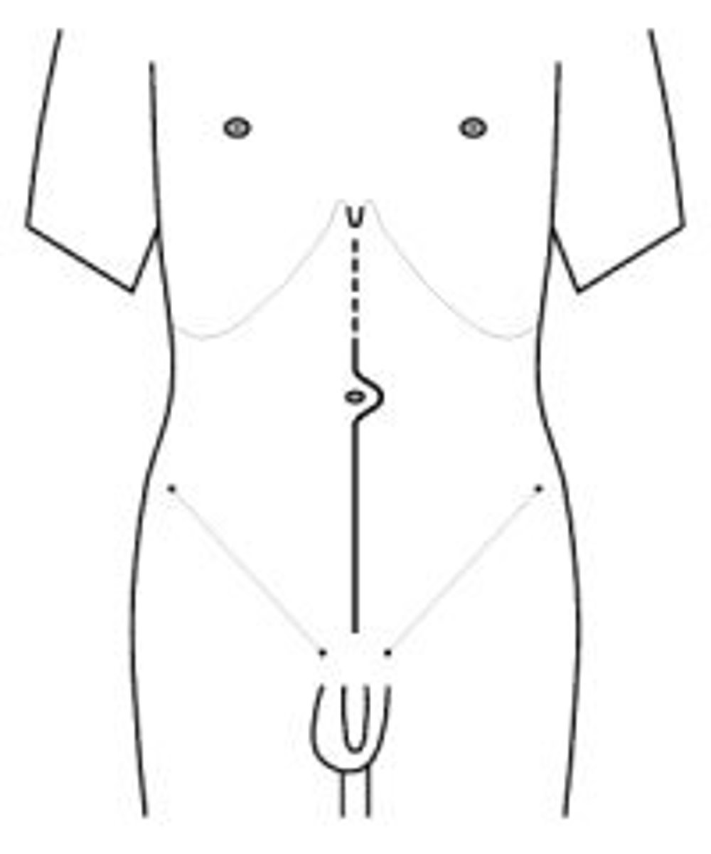 <p>what incision is this</p>