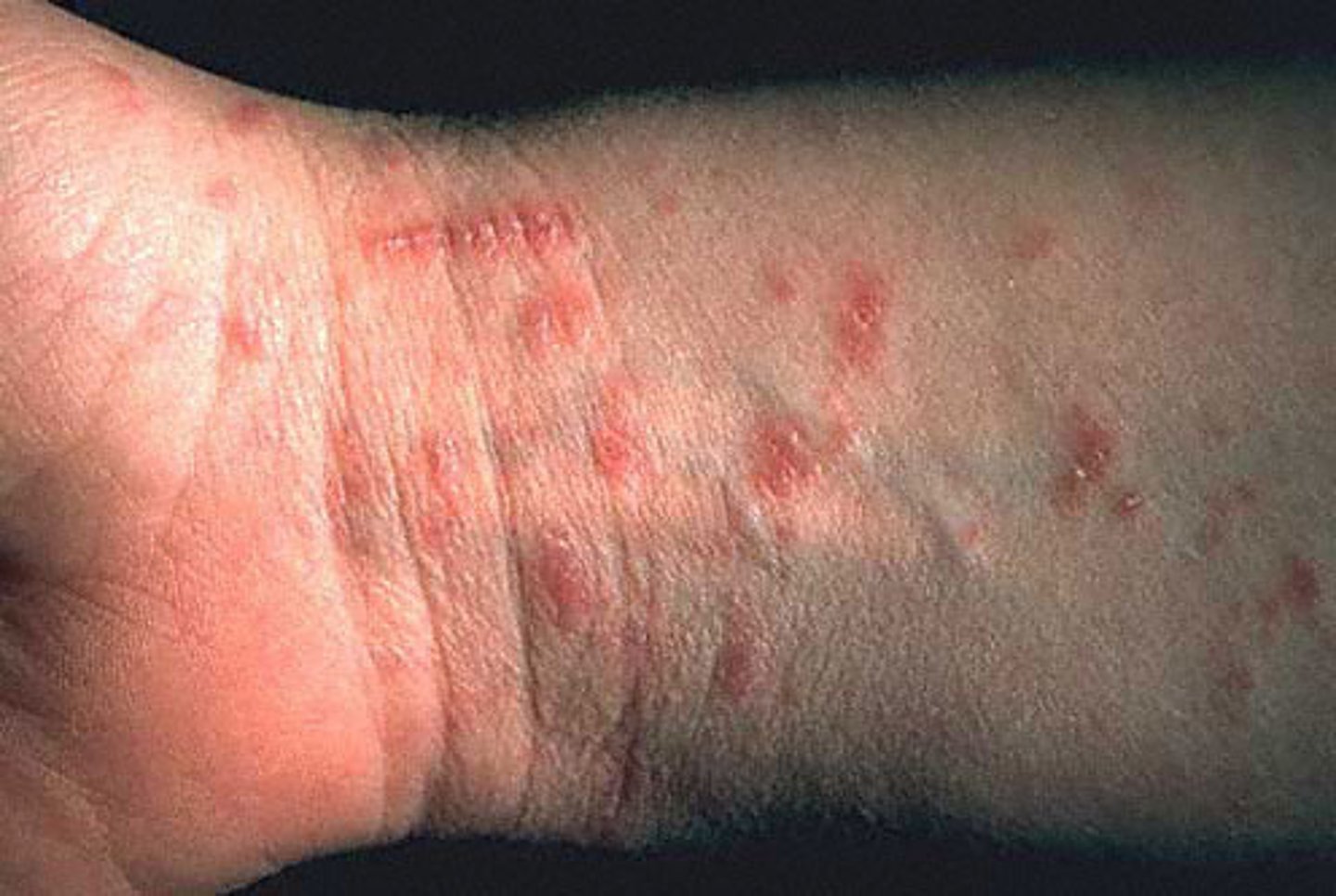 <p>dx: scabies (caused by sarcoptes scabiei) - possible to see eggs/mites on scraping/microscopy w/ mineral oil</p><p>tx: DOC Permethrin cream applied from neck down and left on for 8-14 hrs before showing with repeat tx in 1 week + washing all bedding after storing in a bag for at least 72h; Lindane also indicated but more SE of seizure, teratogenic, etc; for pregnant women and infants 6-10% sulfur in petroleum jelly; oral ivermectin if extensive</p>