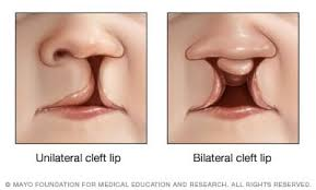 <ul><li><p>the failure/incomplete fusion of the maxillary process and the lateral nasal processes</p></li><li><p>can be uni or bilateral</p></li><li><p>can never have a midline cleft, however, because 1 solid piece of medial nasal process in the middle</p></li></ul><p></p>
