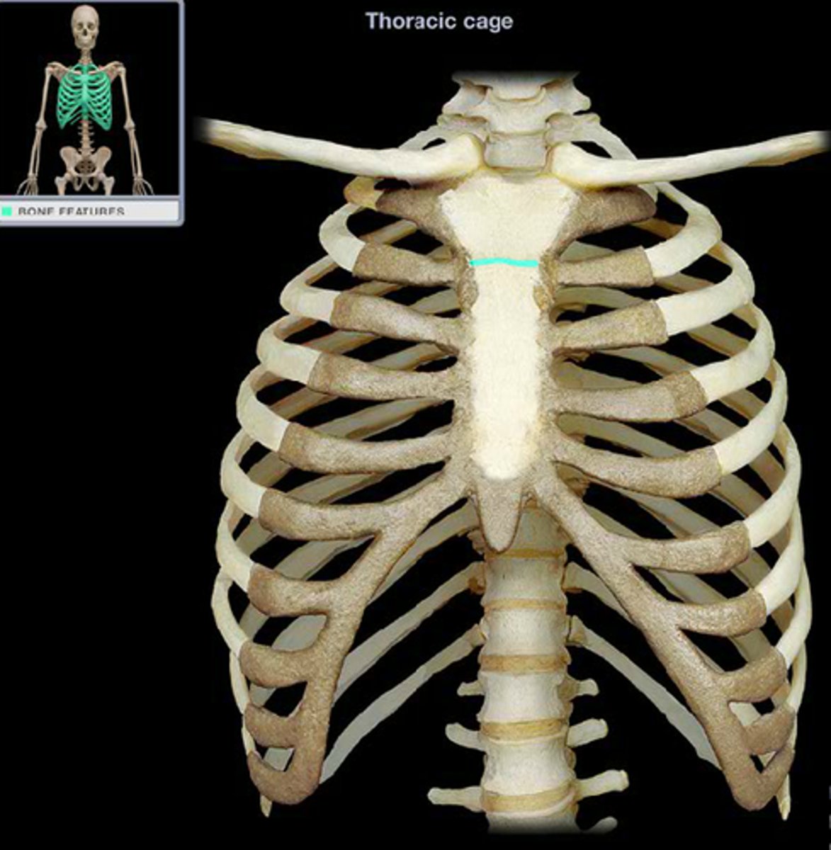 <p>symphysis between manubrium and body of sternum</p>