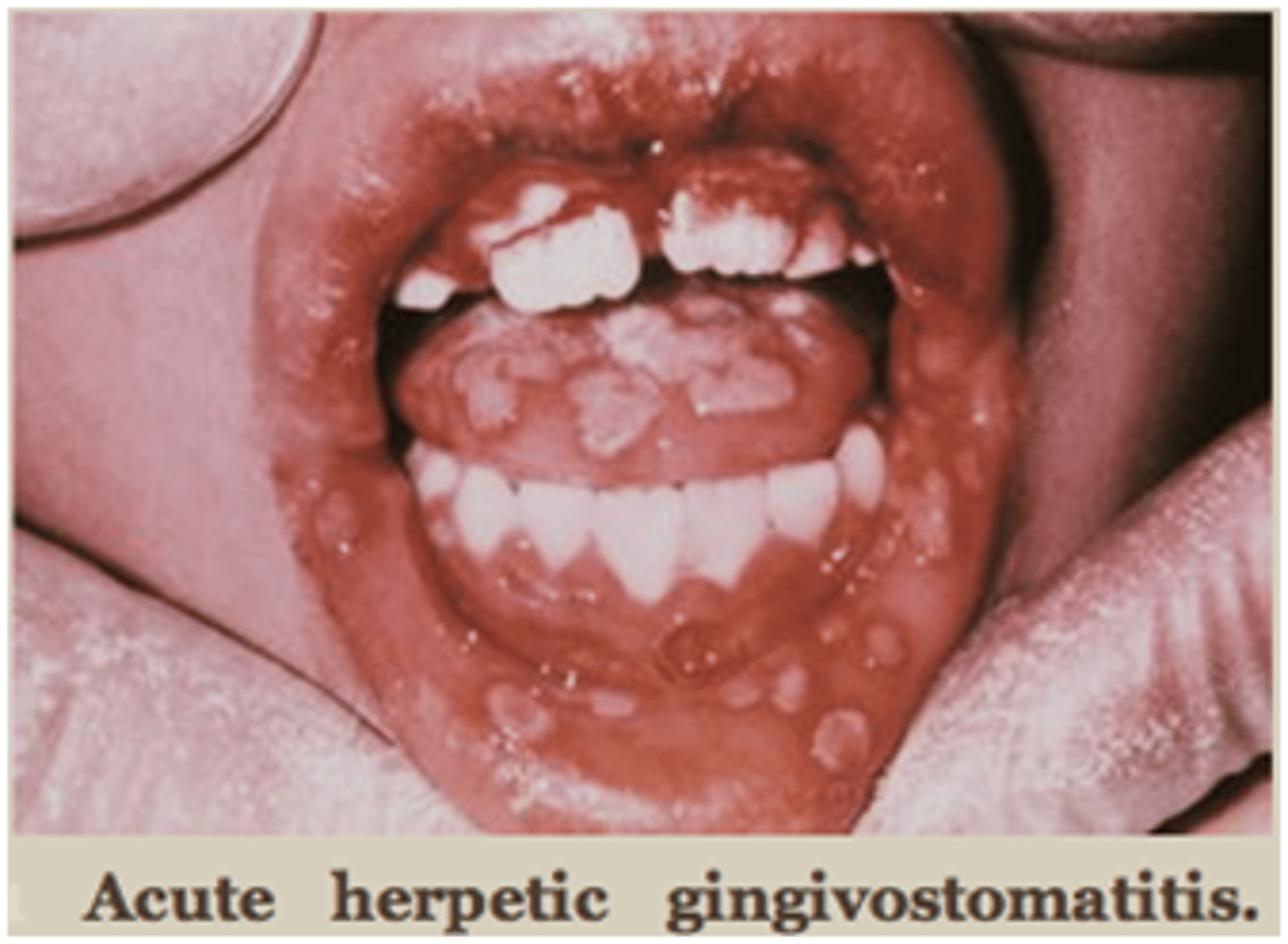 <p>acute herpactic gingivostomatitis</p><p>pallative care with lidocaine rinses and analgesics</p>