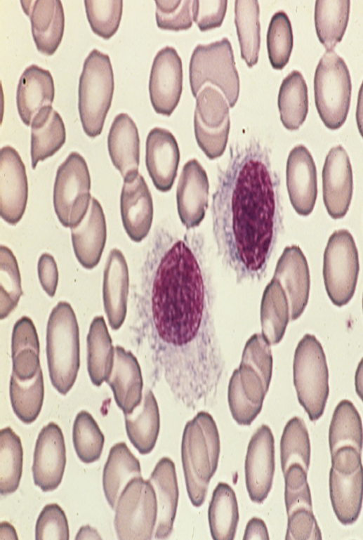 <p>This cell is positive for: CD19, CD20, CD22, IL-2 receptor, and CD25, <strong>CD103 (Highly specific marker).</strong> Trap +</p>