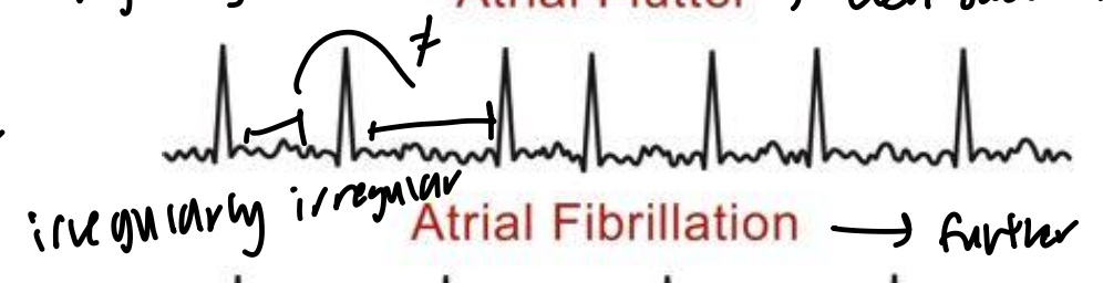 <ul><li><p>further deinvolvement of atrial depolarized state</p></li><li><p>individual cells are depolarizing together</p></li><li><p>“irregularly irregular”</p></li></ul><p></p>