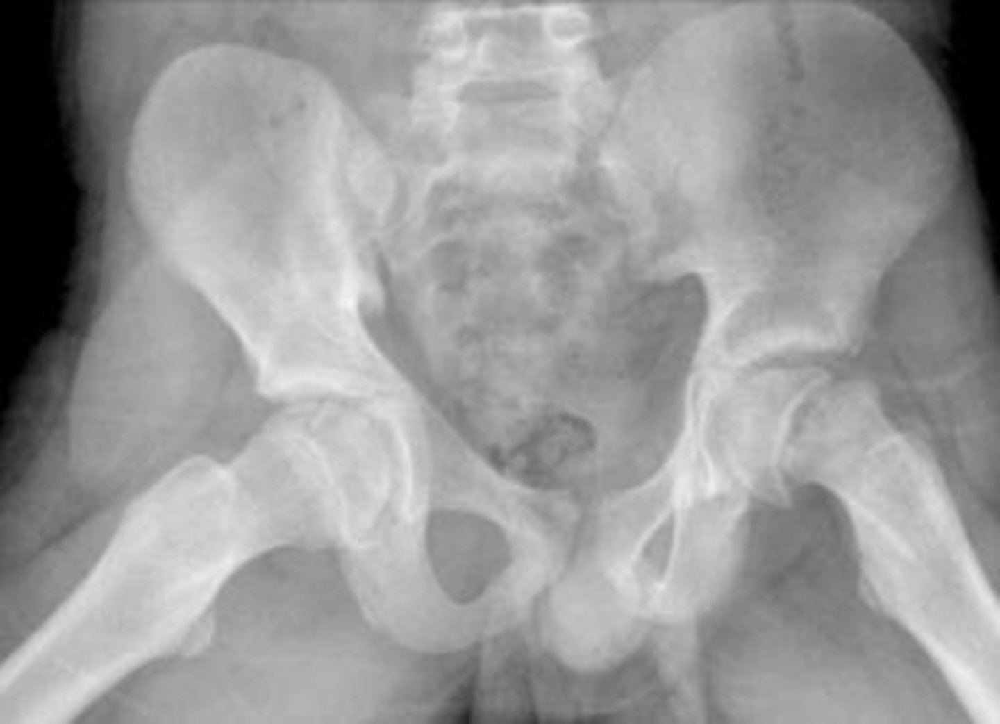 <p>XRAY</p><p>- ice cream falling off cone (L hip in image)</p><p>- growth plate widening or lucency</p><p>- blurring of proximal femoral metaphysis</p>