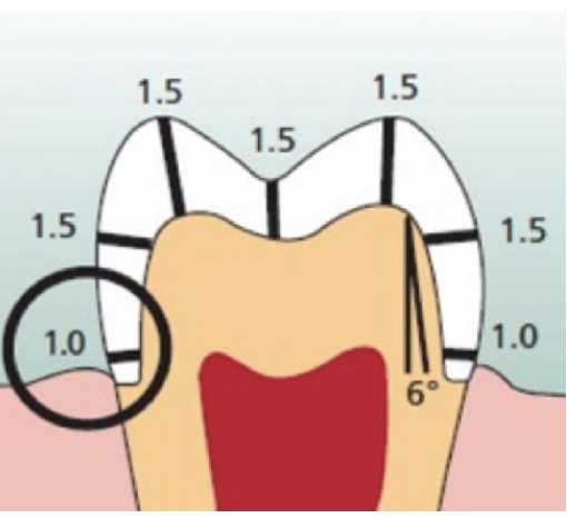 <ul><li><p>funx cusp: 1.5 mm </p></li><li><p>non-funx cusp: 1.5 mm </p></li><li><p>funx cusp bevel: 1.5 mm </p></li><li><p>central groove: 1.5 mm </p></li><li><p>axial wall: 1-1.5 mm </p></li><li><p>cervical finish line: 1 mm </p></li></ul><p></p>