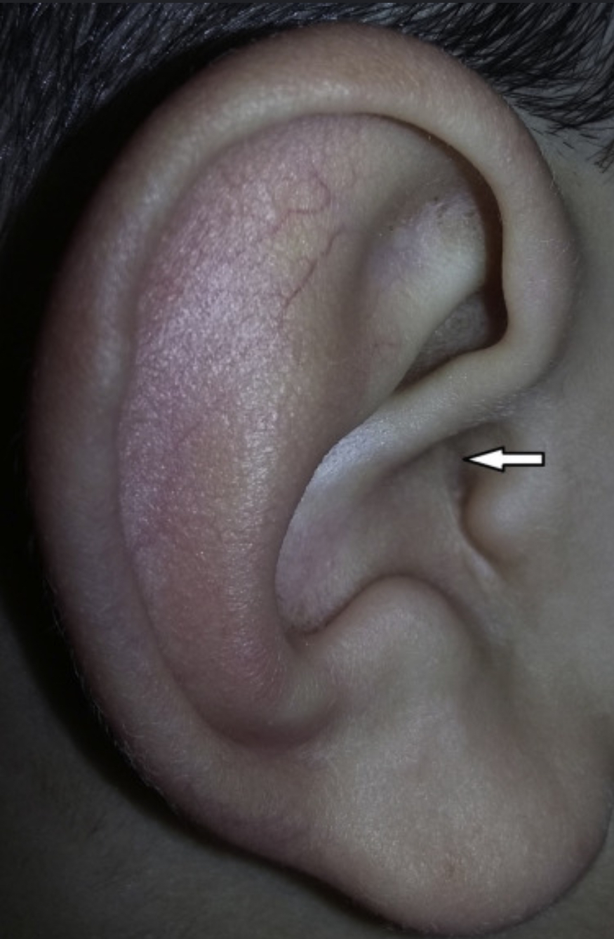 <p>Location: External Auditory Canal</p><ul><li><p>Narrowing of the external auditory canal </p></li></ul><p></p>