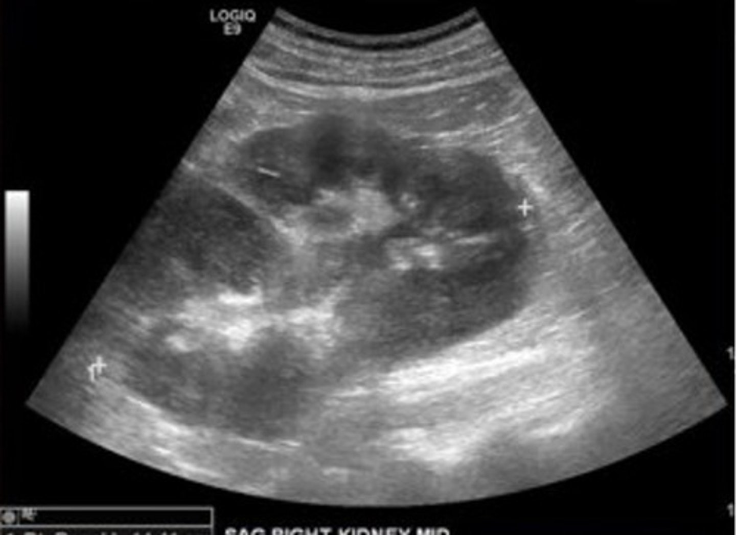 <p>Renal lymphoma sonographic features include ___ kidneys with ___ outlines, multiple ___ masses, and enlarged retroperitoneal ___ </p>