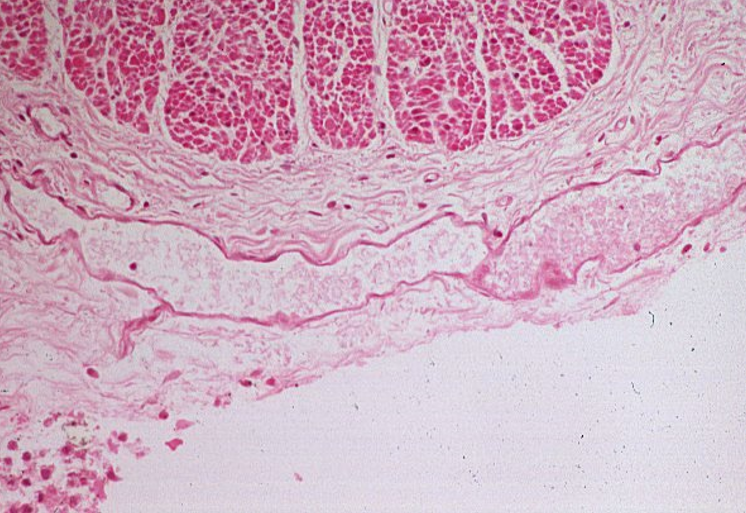 <p>Lymphatic vessel.</p><ul><li><p><strong>Thin, irregular walls</strong> with a lack of well-defined tunics, unlike arteries and veins, which have structured layers.</p></li><li><p><strong>No red blood cells in the lumen</strong>, as lymphatic vessels carry lymph, not blood.The lumen appears clear</p></li><li><p><strong>Valves may be visible</strong> as thin folds of endothelium, preventing backflow of lymph.</p></li><li><p><strong>Surrounding loose connective tissue</strong>, typical of lymphatic vessels, which often run parallel to veins.</p></li></ul><p></p>