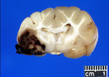 <p>what type of hemorhage?</p>