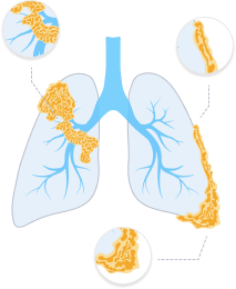 <p><strong>Causation</strong> - No Causal Link to Harm</p><p><u>Facts</u>: A man who had worked for two different companies handling asbestos developed mesothelioma. The man wanted to make a claim against both companies A and B. It was not clear if he was entitled to claim compensation from either because the exposure could have taken place during either term of employment.</p><p><u>Issue</u>: From which employer, if any, were the claimants entitled to claim compensation from their tortious negligence in exposing their employees to asbestos.</p><p><u>Law</u>:</p><ul><li><p>The claimant could claim total compensation from both A and B</p><ul><li><p>Where the ‘but for’ test cannot be reasonably or fairly applied, the ‘materially increased risk’ of harm test may be used</p></li></ul></li><li><p>The materially increased risk of exposure to asbestos by both A and B caused mesothelioma in the plaintiff.</p></li></ul>