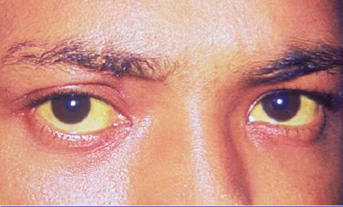 <p>yellowing of the sclera due to jaundice</p>