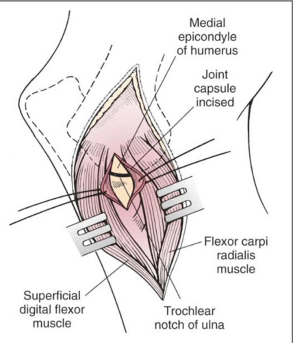 <p>what method of open FCP exposure is shown here</p>