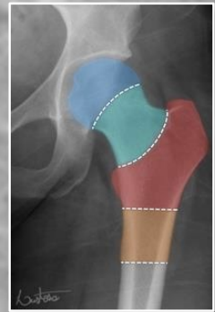 <ul><li><p>intracapsular: involving the head or neck of femur</p><ul><li><p>fracture through neck of femur (most common in younger patients)</p><ul><li><p>mechanism of trauma: axial loading during high force trauma (feet on dashboard)</p></li><li><p>if hip is abducted position</p></li></ul></li></ul></li><li><p>extracapsular: involving the femur excluding head or neck of femur</p><ul><li><p>fracture through the trochanters</p></li></ul></li></ul><p></p>