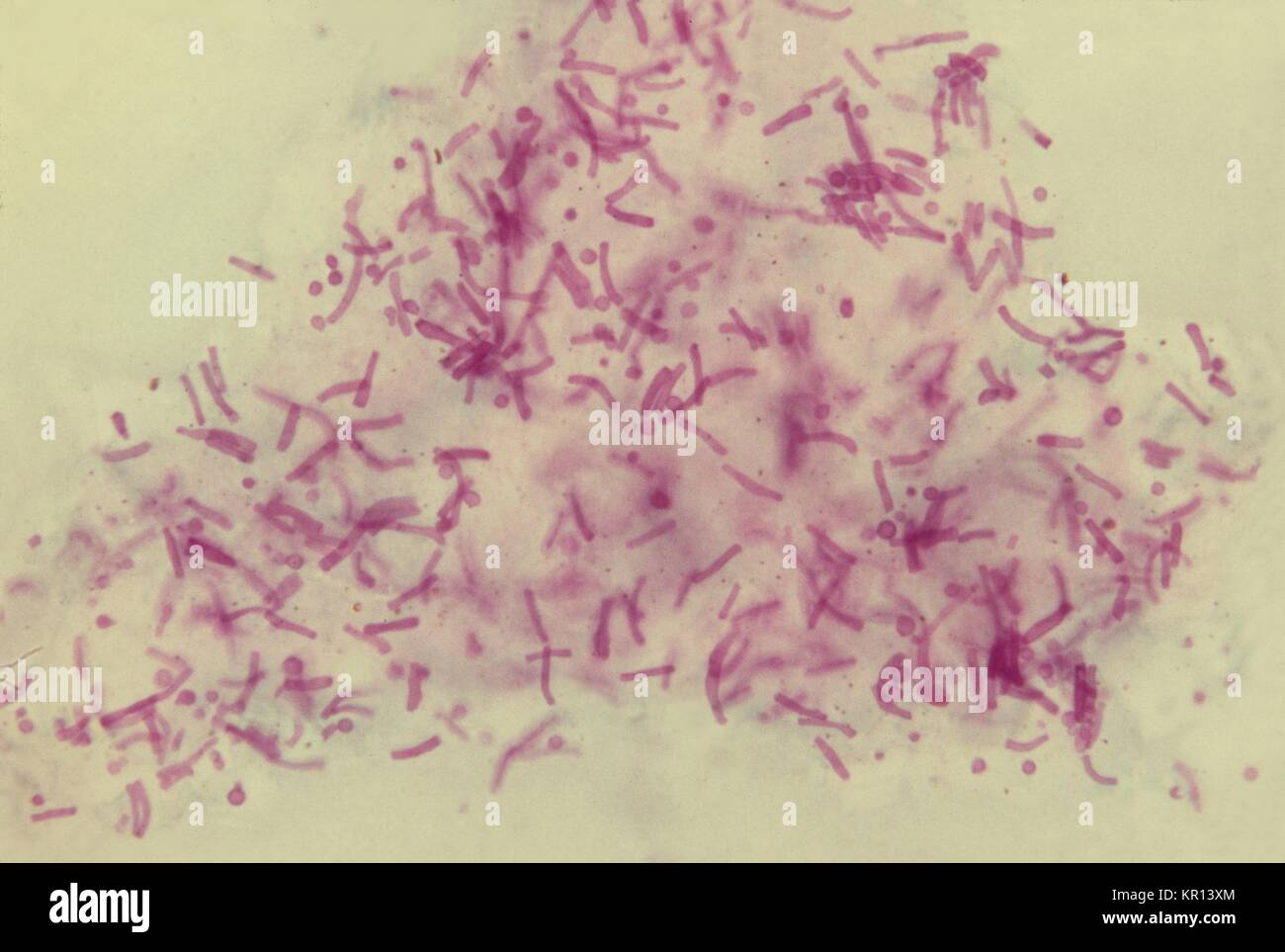 <p>TINEA VERSICOLOR</p><p>KOH PREP</p><p></p>