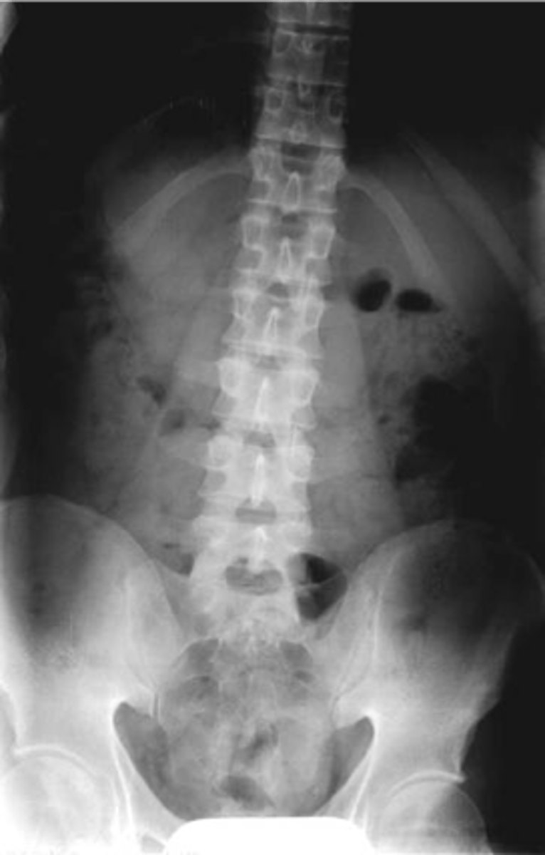 <p>ID lumbar lordosis</p>