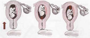 <p>the uterus is pushed with a finger to feel whether a foetus moves away and returns again</p>